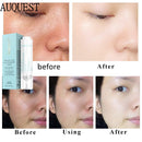 15ML AUQUEST Salicylic Acid Acne Treatment Face Cream Anti-acne Gel Shrink Pores Moisturizing Serum Remove Blackheads Skin Care
