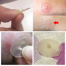 BREYLEE Acne Pimple Patch Stickers Acne Treatment Pimple Remover Tool Blemish Spot Facial Mask Skin Care Waterproof 22 Patches