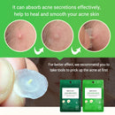 BREYLEE Acne Pimple Patch Stickers Acne Treatment Pimple Remover Tool Blemish Spot Facial Mask Skin Care Waterproof 22 Patches