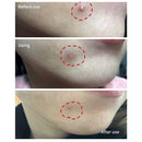 BREYLEE Acne Pimple Patch Stickers Acne Treatment Pimple Remover Tool Blemish Spot Facial Mask Skin Care Waterproof 22 Patches