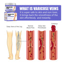 Effective Varicose Veins Relief Cream Relieve Vasculitis Phlebitis Spider Pain Treatment Ointment Medical Plaster Body Care 30g