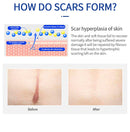 Scar Removal Cream Gel Remove Acne Spots Treatment Stretch Marks Burn Surgical Scar Repair Cream Smoothing Whitening Skin Beauty