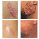 Acne Surgical Stretch Marks Removal Scar Cream Pimples Face Gel Child Acne Smoothening Whitening Body Skin Care Pigmentation