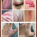 Acne Surgical Stretch Marks Removal Scar Cream Pimples Face Gel Child Acne Smoothening Whitening Body Skin Care Pigmentation