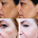 20g Effective Freckle Cream Remove Melasma Dark Spots Whitening Melanin Corrector Treat Acne Scars Brighten Lightening Cream