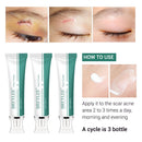 BREYLEE Scar Removal Cream Stretch Marks Removal Acne Scars Skin Repair Whitening Cream Dark Spot Remover For Face Skin Care
