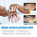 20g Herbal Extract Vitiligo Ointment Remove Ringworm White Spot Removal Skin White Spot Leukoplakia Disease Treatment Cream
