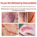 Acne Surgical Stretch Marks Removal Scar Cream Pimples Face Gel Child Acne Smoothening Whitening Body Skin Care Pigmentation