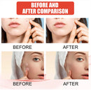 144pcs/set Face Men Women Skin Care Acne Pimple Patch 2 Sizes Invisible Professional Healing Absorbing Spot Sticker Covering