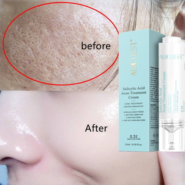 15ML AUQUEST Salicylic Acid Acne Treatment Face Cream Anti-acne Gel Shrink Pores Moisturizing Serum Remove Blackheads Skin Care
