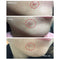 BREYLEE Acne Pimple Patch  Stickers Acne Treatment Pimple Remover Tool Blemish Spot Facial Mask Skin Care  Waterproof 22 Patches