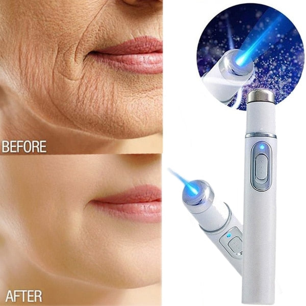 Acne Wrinkle Removal Laser Pen Skin Spots Removal Anti Varicose Spider Vein Eraser Treatment Portable Medical Blue Light Therapy
