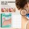 120-480pcs Skin Tag Remover Patch Wart Treatment Stickers Absorb Plaster Hydrocolloid Gel Anti-infection Invisible Skin Care