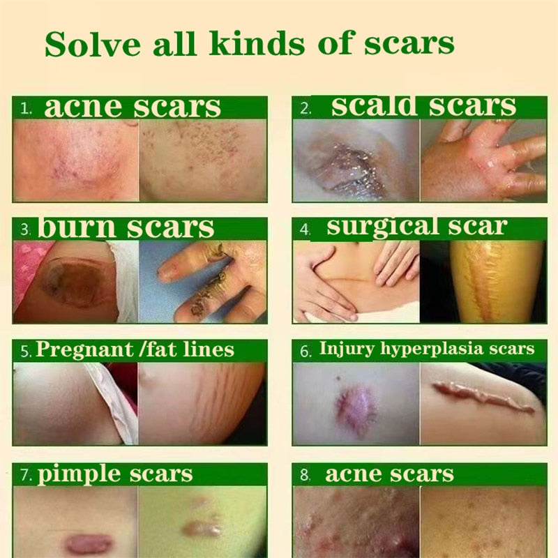 Acne Surgical Stretch Marks Removal Scar Cream Pimples Face Gel Child Acne Smoothening Whitening Body Skin Care Pigmentation