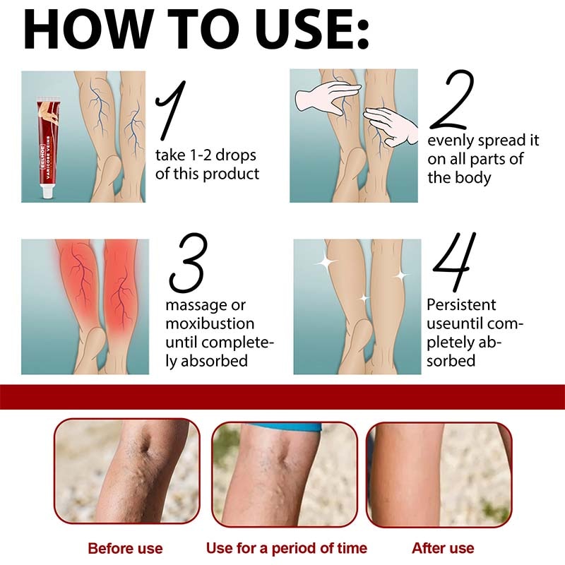 Effective Herbal Varicose Veins Relief Cream Vasculitis Phlebitis Spider Pain Relief Ointment Herb Plaster Beauty Body Care 20g