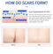 Scar Removal Cream Gel Remove Acne Spots Treatment Stretch Marks Burn Surgical Scar Repair Cream Smoothing Whitening Skin Beauty