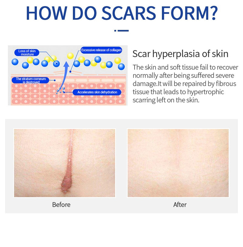 Scar Removal Cream Gel Remove Acne Spots Treatment Stretch Marks Burn Surgical Scar Repair Cream Smoothing Whitening Skin Beauty