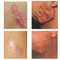 Acne Surgical Stretch Marks Removal Scar Cream Pimples Face Gel Child Acne Smoothening Whitening Body Skin Care Pigmentation