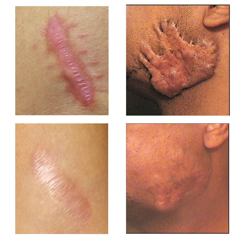 Acne Surgical Stretch Marks Removal Scar Cream Pimples Face Gel Child Acne Smoothening Whitening Body Skin Care Pigmentation