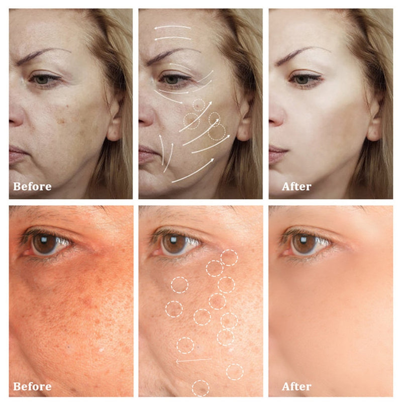 Freckle Removal Cream Whitening Cream Remove Dark Spots Melanin Melasma Pigmentation Anti-Aging Brighten Face Skin Care Cosmetic