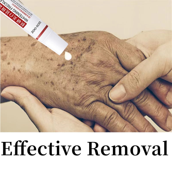 20g Effective  Freckle Cream Remove Melasma Dark Spots Whitening Melanin Corrector Treat Acne Scars Brighten Lightening Cream