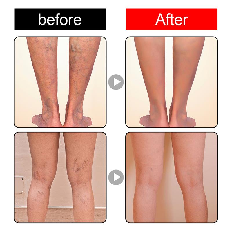 Effective Herbal Varicose Veins Relief Cream Vasculitis Phlebitis Spider Pain Relief Ointment Herb Plaster Beauty Body Care 20g