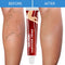 Effective Herbal Varicose Veins Relief Cream Vasculitis Phlebitis Spider Pain Relief Ointment Herb Plaster Beauty Body Care 20g