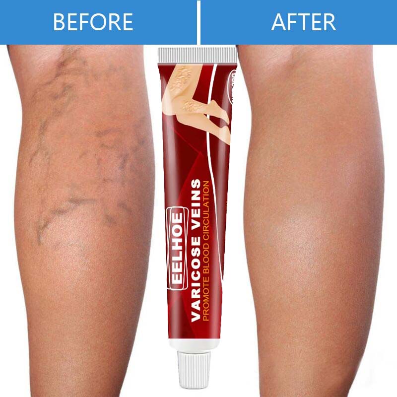 Effective Herbal Varicose Veins Relief Cream Vasculitis Phlebitis Spider Pain Relief Ointment Herb Plaster Beauty Body Care 20g
