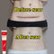 Acne Surgical Stretch Marks Removal Scar Cream Pimples Face Gel Child Acne Smoothening Whitening Body Skin Care Pigmentation