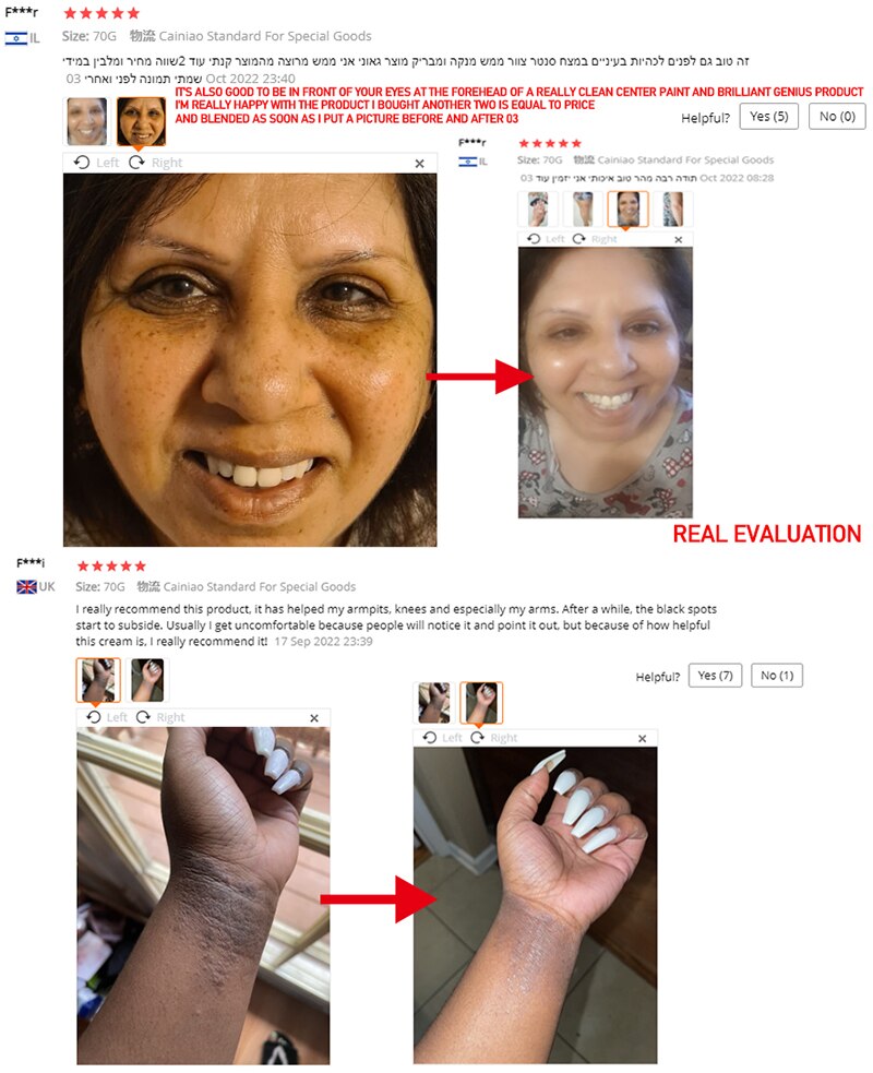 Anti Acanthosis Nigricans Whitening Cream Remove Melanin Armpit Elbow Private Care Products Body Butt Black Sitting Print Remove