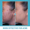 AUQUEST Salicylic Acid Acne Face Cream Skin Care Hyaluronic Acid Black Dots Acne Pimple Remove Treatment Cream Beauty Health