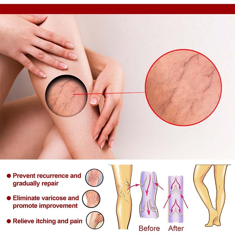 Effective Herbal Varicose Veins Relief Cream Vasculitis Phlebitis Spider Pain Relief Ointment Herb Plaster Beauty Body Care 20g