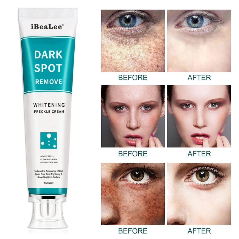 Whitening Freckle Cream Remove Melasma Cream Remove Dark Spots Melanin Melasma Remover Brighten Skin Anti-Aging Skin Lightening