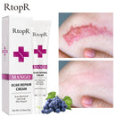 Skin Scar Removal Cream Face Fade Scars Cream Acne Spots Acne Treatment Blackhead Whitening Cream Anti Scar Stretch Marks Beauty