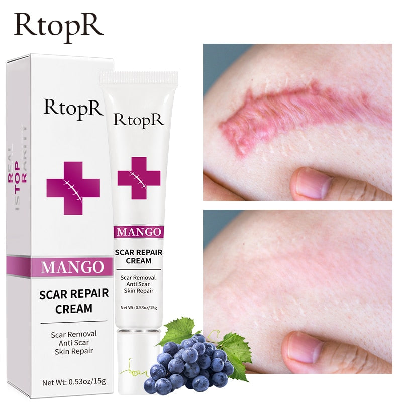 Skin Scar Removal Cream Face Fade Scars Cream Acne Spots Acne Treatment Blackhead Whitening Cream Anti Scar Stretch Marks Beauty