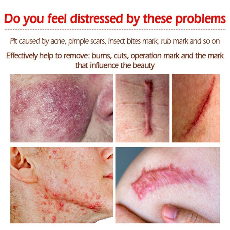 Acne Surgical Stretch Marks Removal Scar Cream Pimples Face Gel Child Acne Smoothening Whitening Body Skin Care Pigmentation