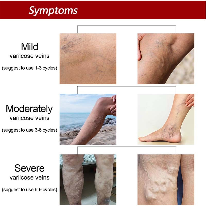 Effective Herbal Varicose Veins Relief Cream Vasculitis Phlebitis Spider Pain Relief Ointment Herb Plaster Beauty Body Care 20g
