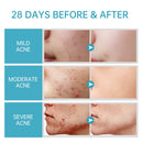 AUQUEST Salicylic Acid Acne Face Cream Skin Care Hyaluronic Acid Black Dots Acne Pimple Remove Treatment Cream Beauty Health