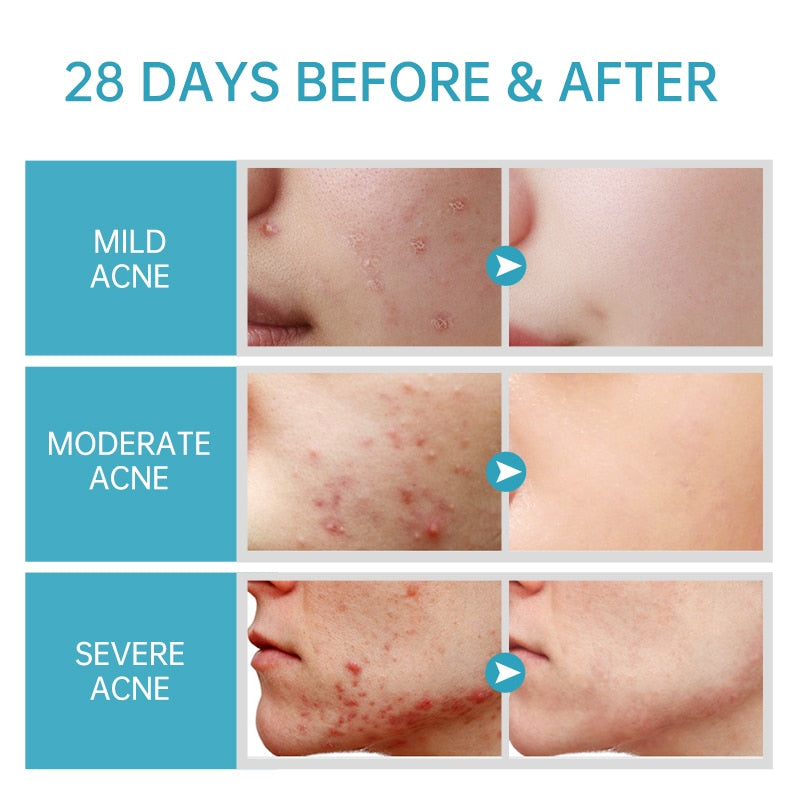 AUQUEST Salicylic Acid Acne Face Cream Skin Care Hyaluronic Acid Black Dots Acne Pimple Remove Treatment Cream Beauty Health